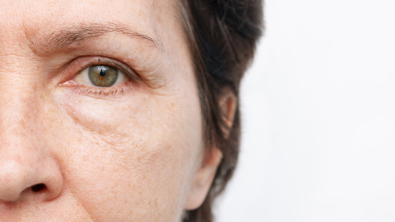 Woman with a puffy eye